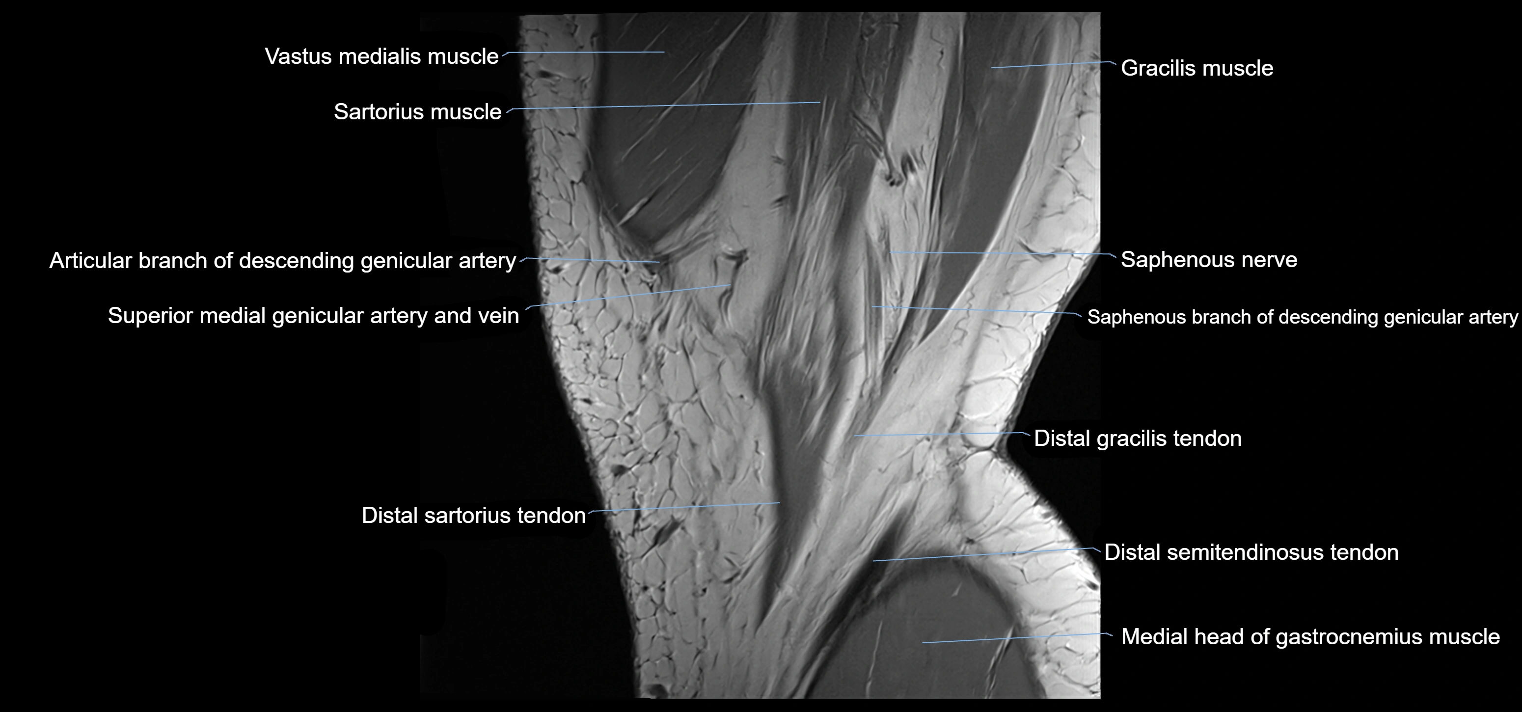 MRI knee sagittal cross sectional anatomy labelled 3T radiology image-00005.webp